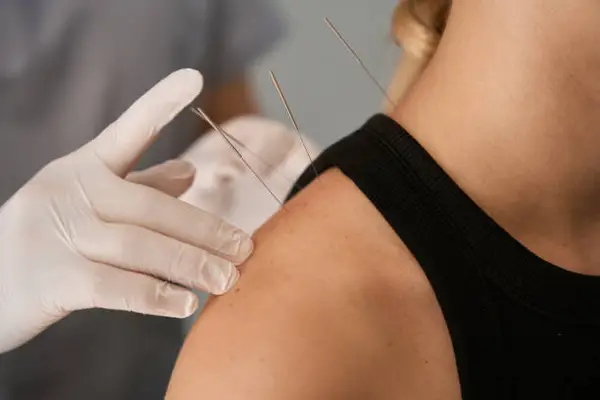Acupuncture points  for back pain