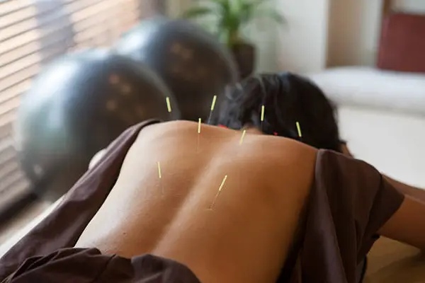 Acupuncture points  for back pain