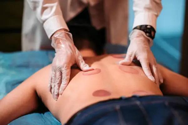 ancient Chinese cupping