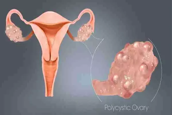 ayurvedic treatment for pcos