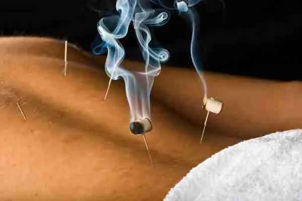 acupuncture therapy