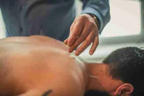 acupuncture therapy