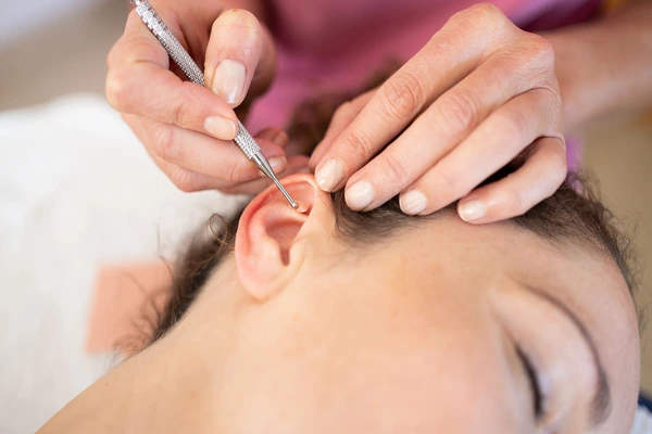 ear acupuncture