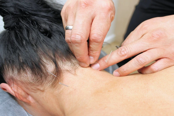 acupuncture therapy