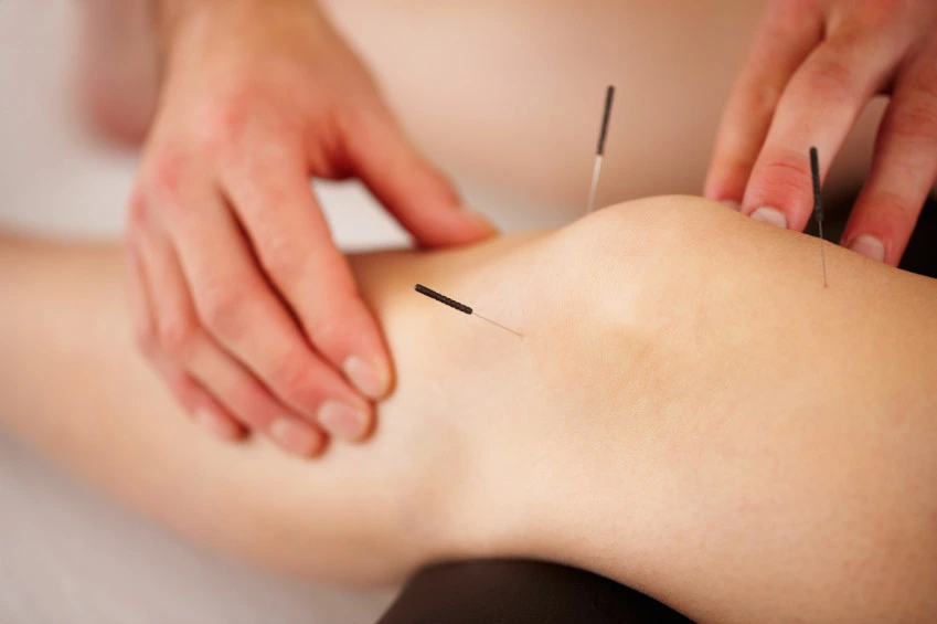 Acupuncture Needles: A Natural Solution for Relieving Joint Pain