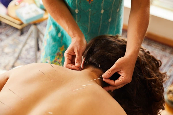 acupuncture treatment 