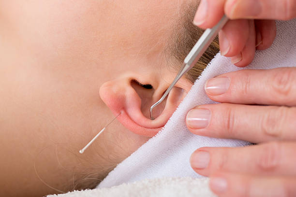 Your Guide to Top-Rated Ear Acupuncture Centres in Bangalore