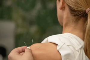 acupunture in delhi